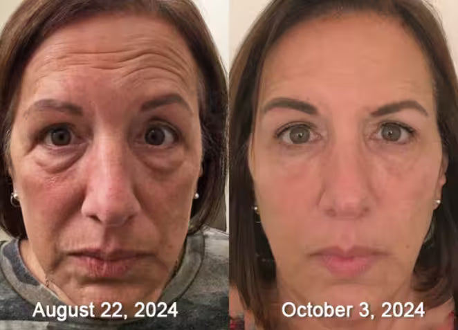 Botox De Veneno De Abeja
