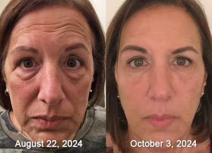 Botox De Veneno De Abeja