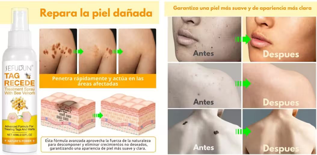 Spray Bee Venom – Elimina verrugas de forma segura, sin dolor ni cicatrices